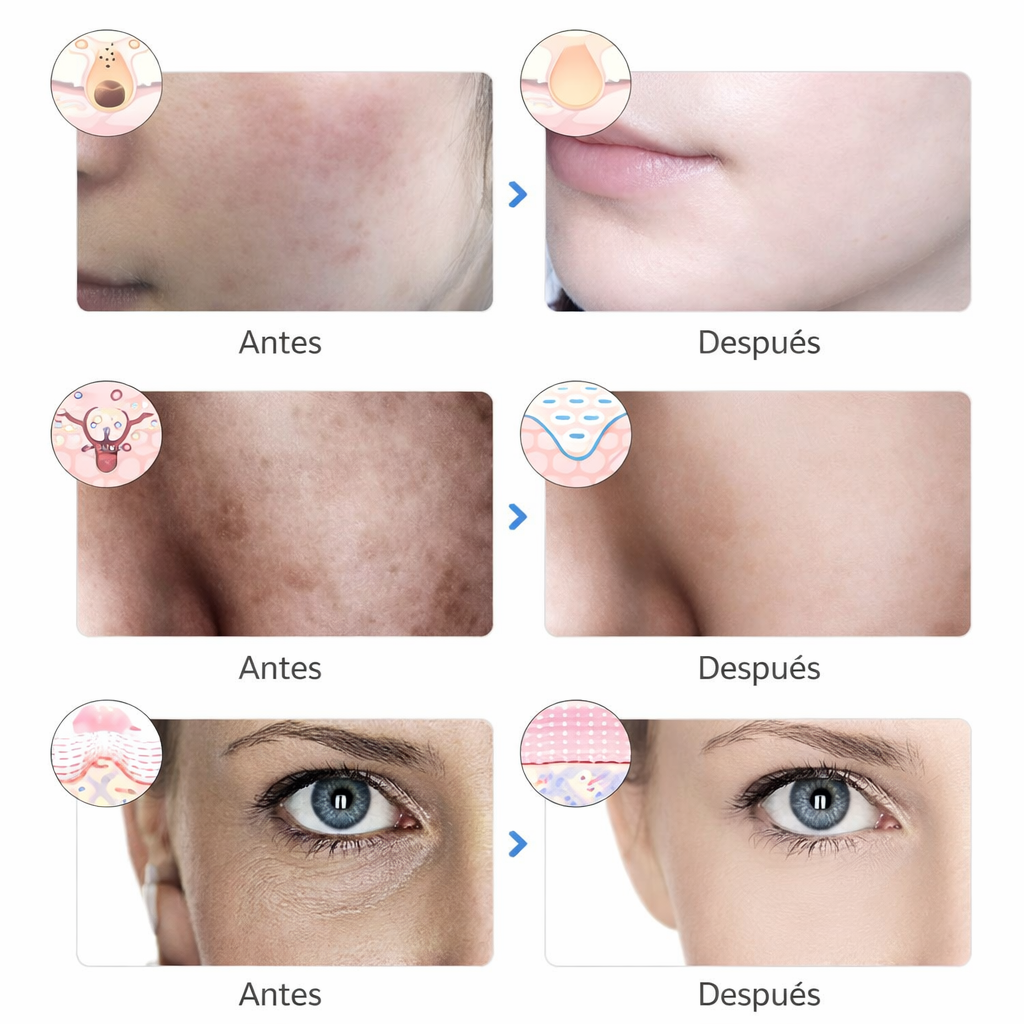 Máscara Facial LED / Terapia de Luz para Acné y Rejuvenecimiento - AuraGlam